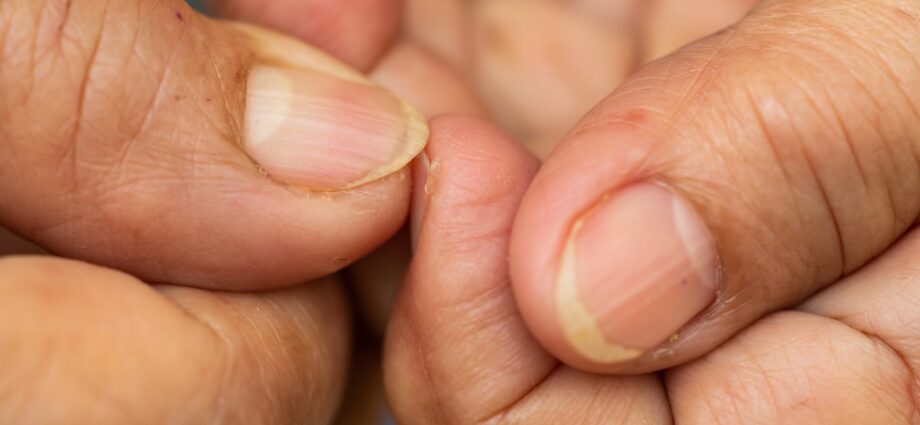 Why nails turn yellow and what to do about it