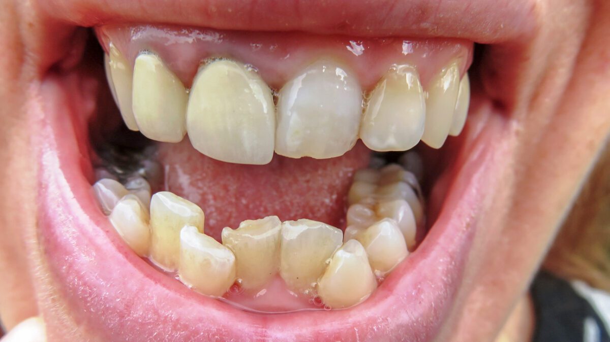 Why teeth grow crooked: how to align teeth? 