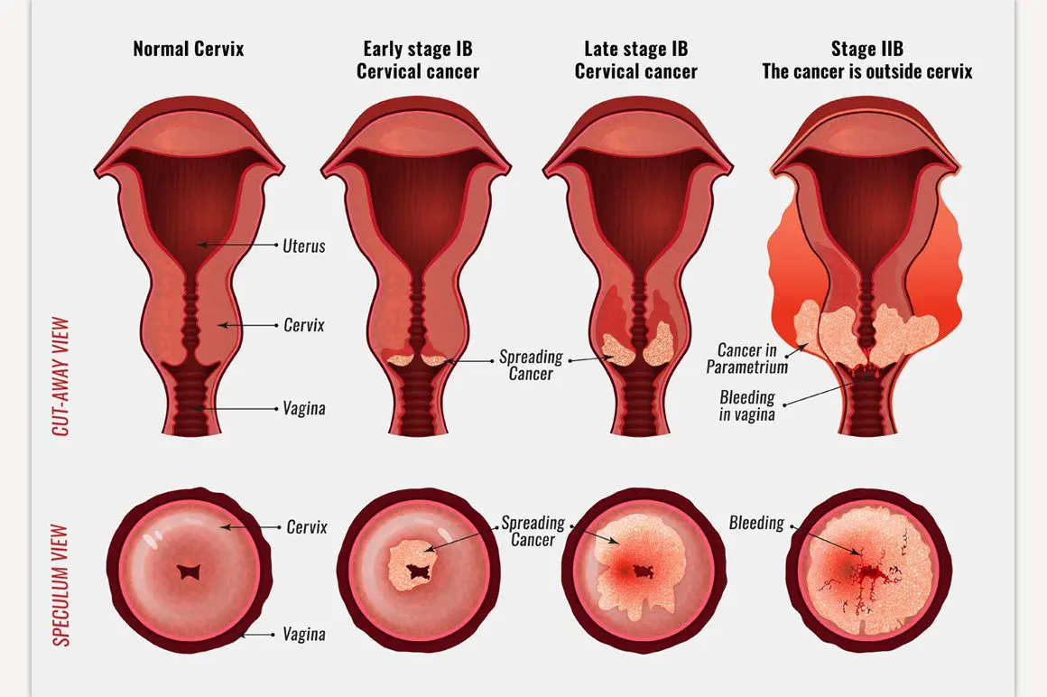 Woman diagnosed with cervical cancer during childbirth