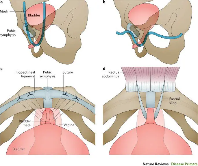 Women Health. Omission. Pelvic prolapse. Urinary incontinence