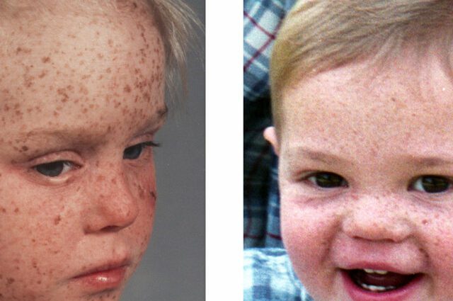 ज़ेरोडर्मन पिगमेंटोसम: चंद्रमा के बच्चों का रोग