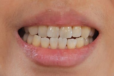 Rumeni zobje: kdo so krivci?