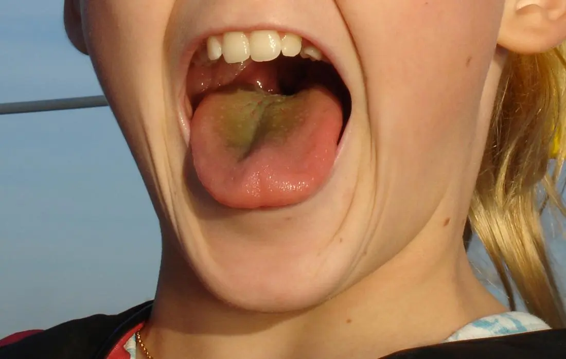 Yellow tongue: should we be concerned about this symptom?