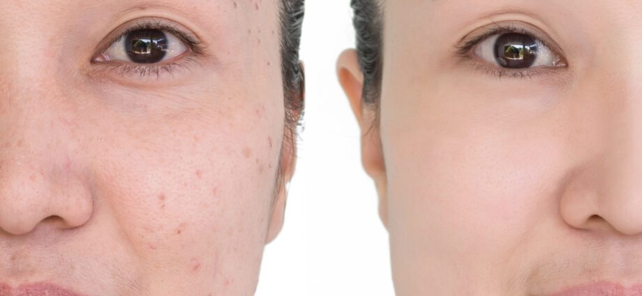 Youth skin laser rejuvenation