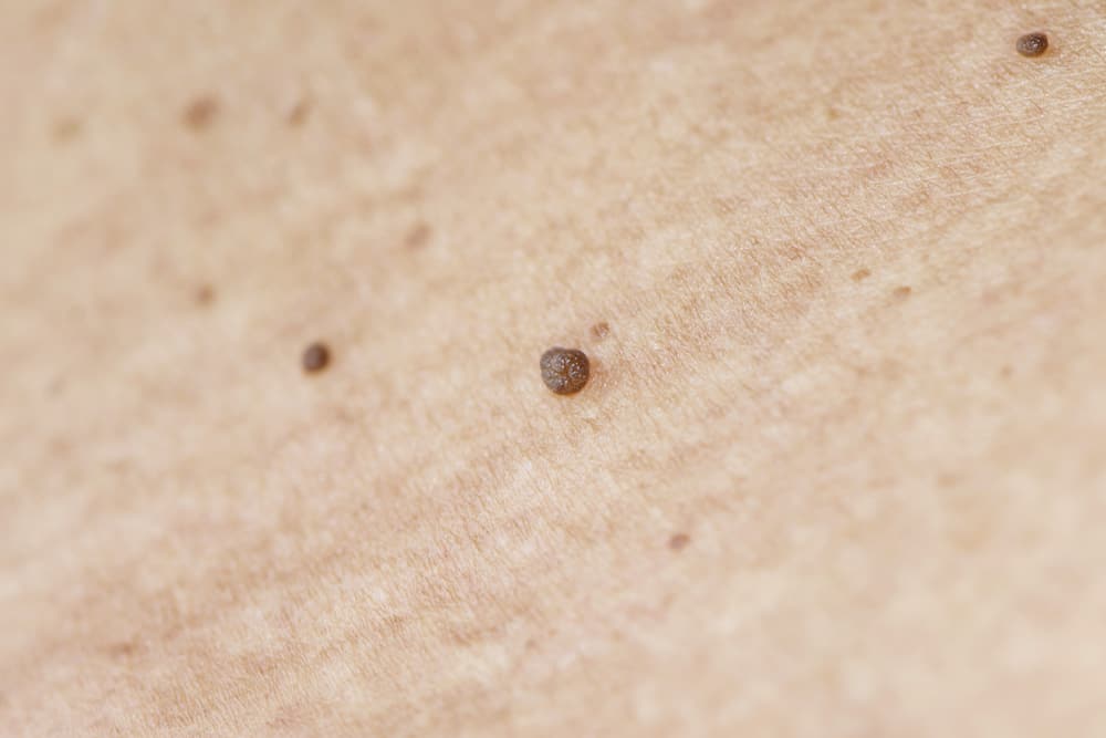 12 natural tips to remove skin tags