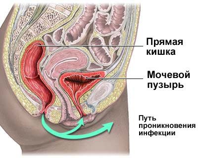 Cystitis: symptoms and treatment of the disease, video