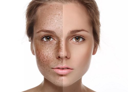 Facial pigmentation: causes and treatment, prevention