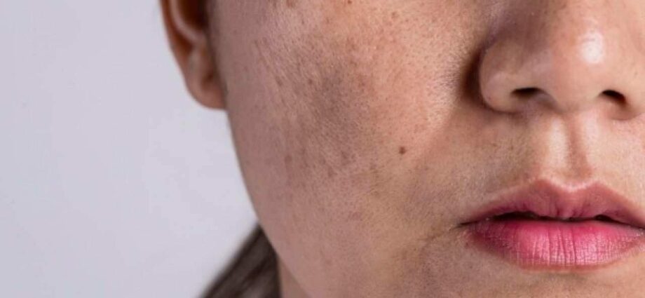 Facial pigmentation: causes and treatment, prevention