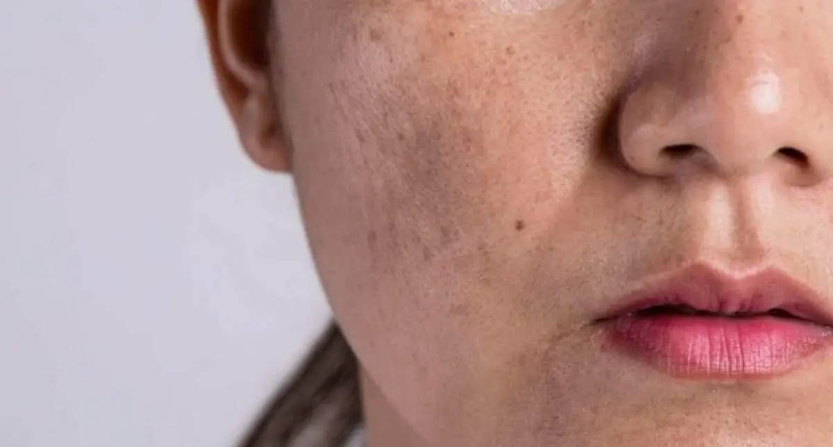 Facial pigmentation: causes and treatment, prevention