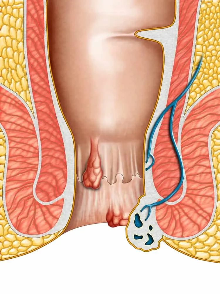 Hemorrhoids: the complete guide to make them disappear