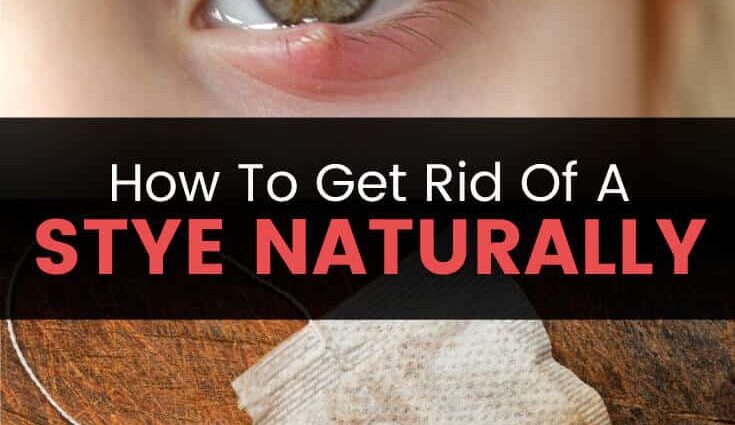 How to cure a stye naturally and quickly? &#8211; Happiness and health