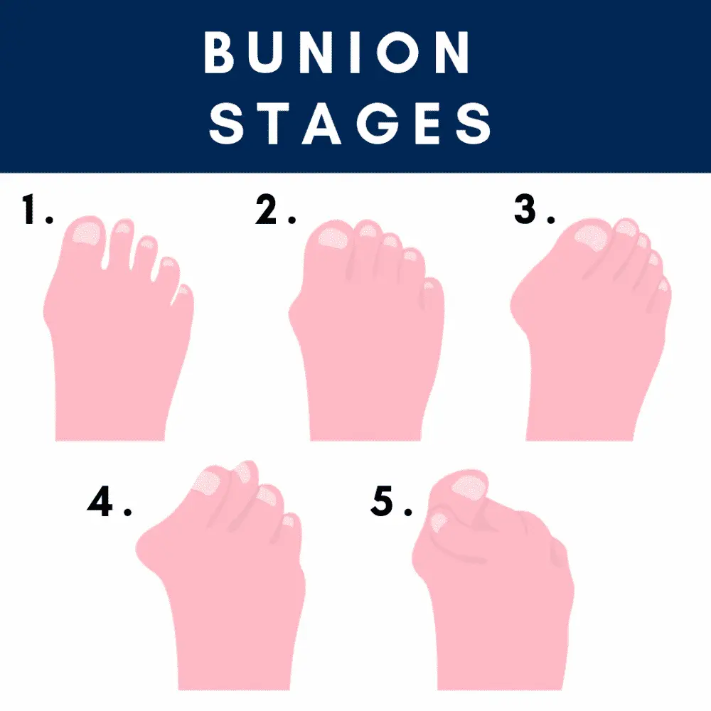 How to cure bunions of the foot in a natural way? &#8211; Happiness and health