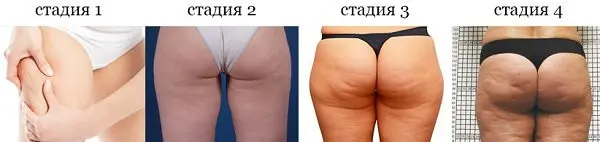 How to deal with cellulite at home