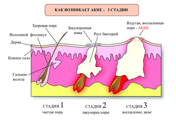 How to get rid of acne: tips that come in handy