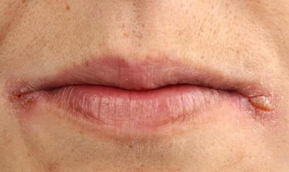 How to get rid of lip corners sticking: simple tips