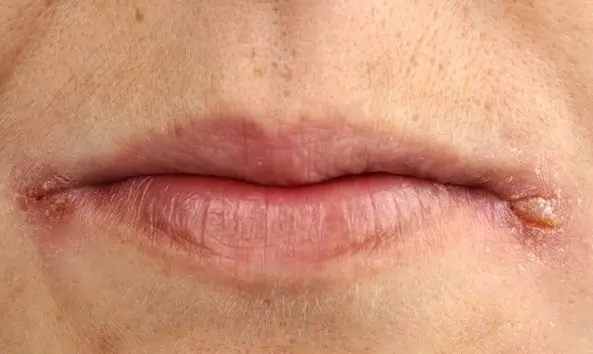 How to get rid of lip corners sticking: simple tips