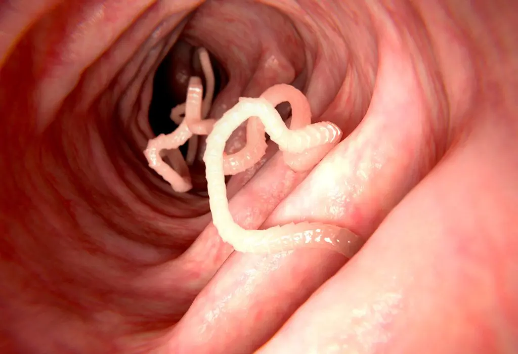 How to get rid of worms in humans: simple methods and herbs