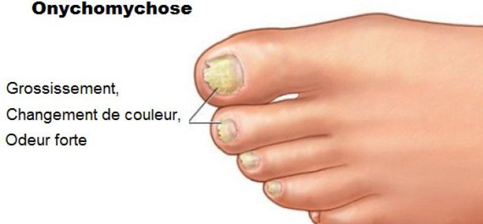 How to get rid of yellow toenails? &#8211; Happiness and health