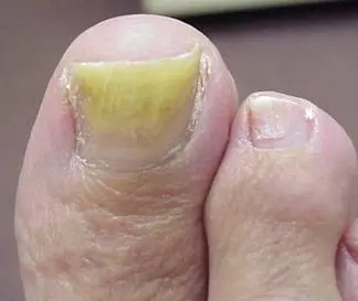 How to get rid of yellow toenails? &#8211; Happiness and health