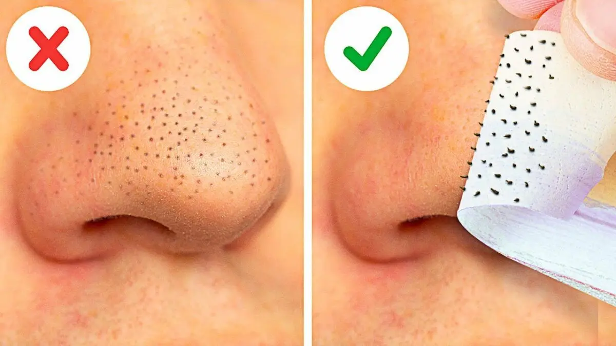 How to remove blackheads