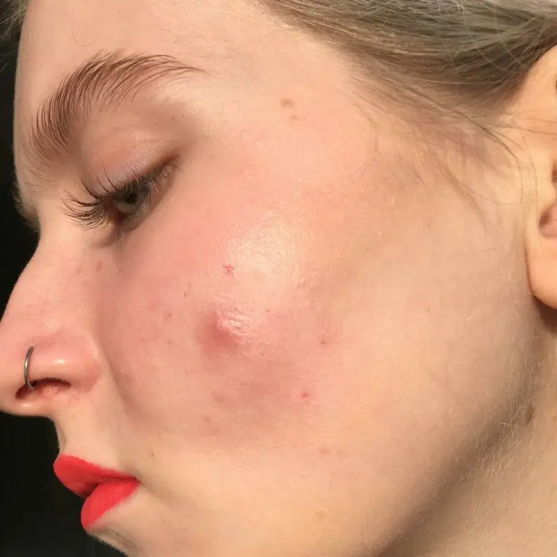 Large pimples under the skin: explanation and solution