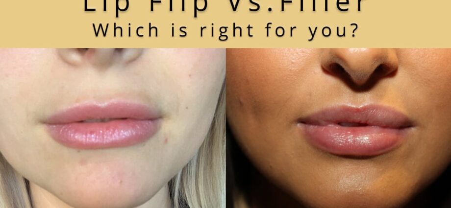 Lip botox: pros and cons of the procedure. Do you need it?