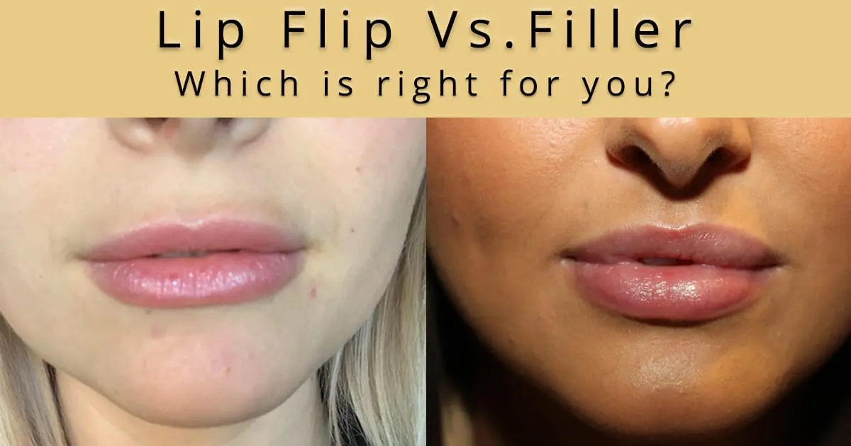 Lip botox: pros and cons of the procedure. Do you need it?