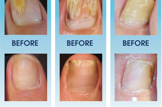 Nail fungus: symptoms and treatment of the disease