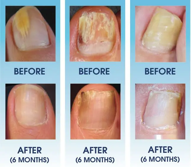 Nail fungus: symptoms and treatment of the disease