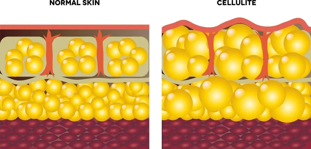 Percutafeine: the miracle cellulite treatment? &#8211; Happiness and health