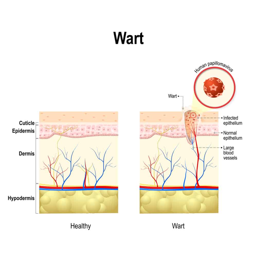 The 10 best natural solutions to cure a plantar wart