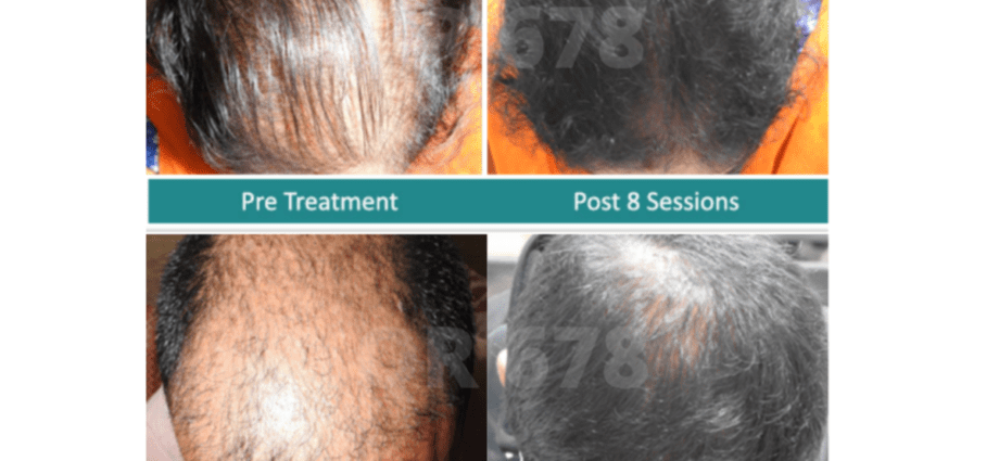 Treatment of baldness in women and men: tips, video