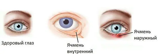 What is barley on the eye and how to treat it, tips, video