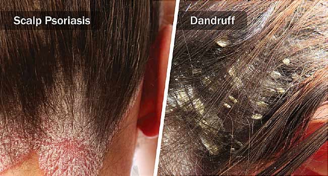 What is dandruff and what causes it in people