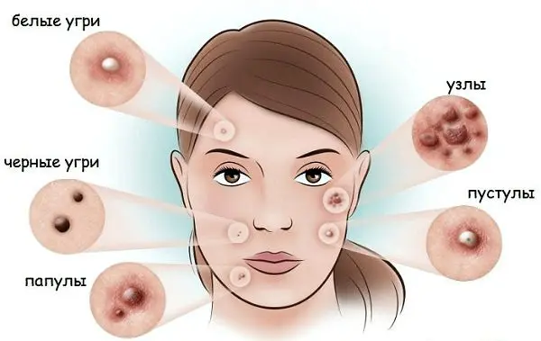 Whiteheads on the face: causes and how to remove them