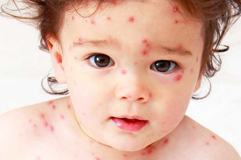 Measles in children