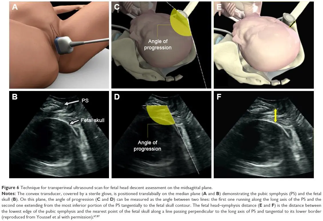 3 D ultrasound, a progress?