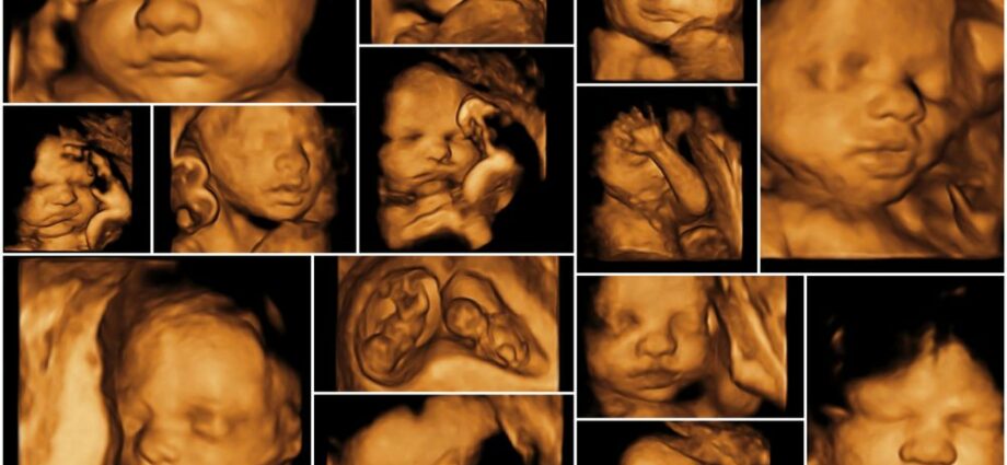 3D ultrasound, what is it for?