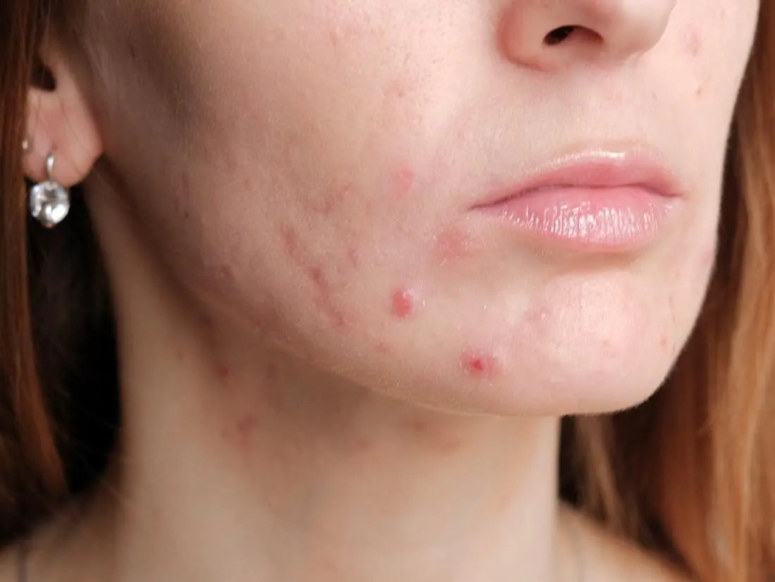 Pregnant: stop acne breakouts!