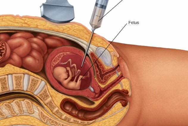 Tout sur l'amniocentèse