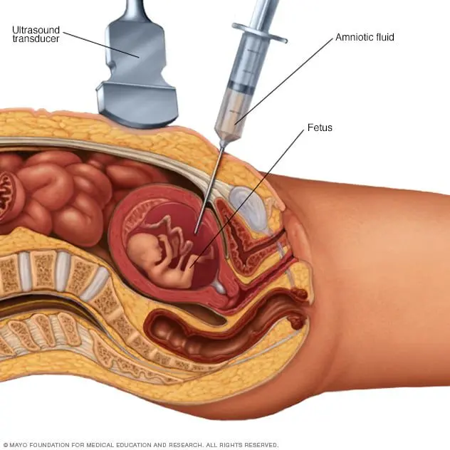 What to do before having an amniocentesis?