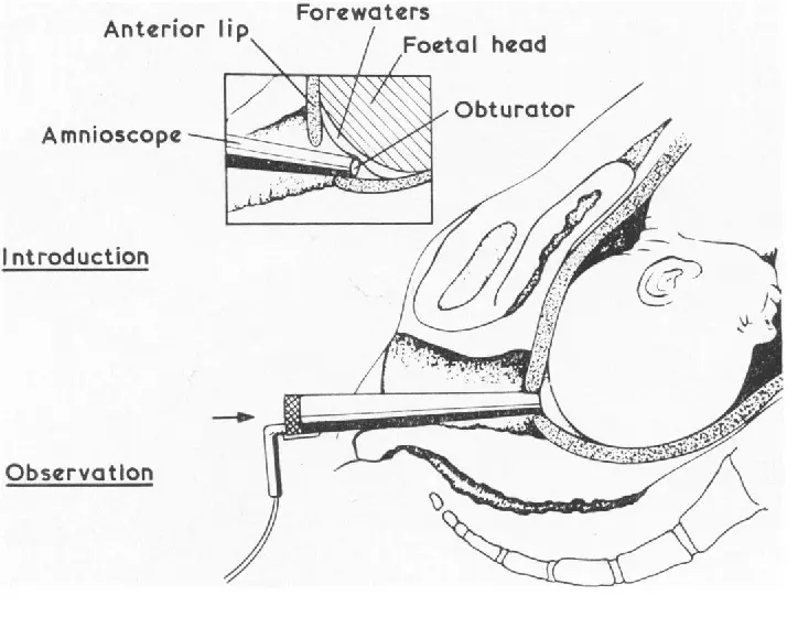 All about amnioscopy