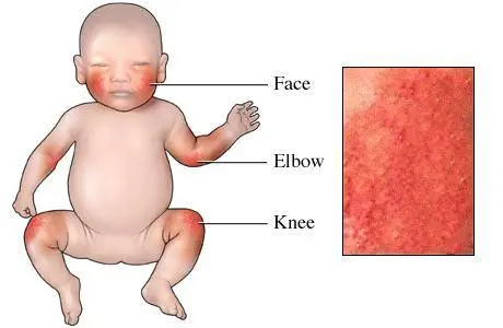 Baby eczema: preventing and treating atopic dermatitis in babies