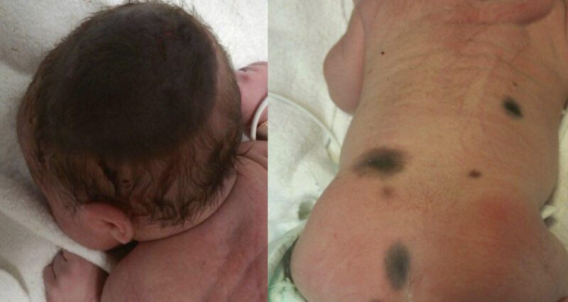 Baby has a congenital nevus: what is this mole?