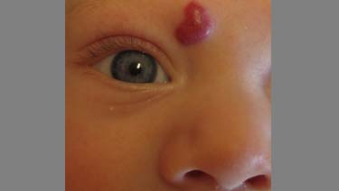 Baby has a hemangioma: how to recognize it and treat it?