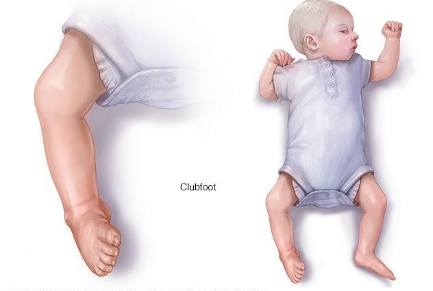 Baby has club foot