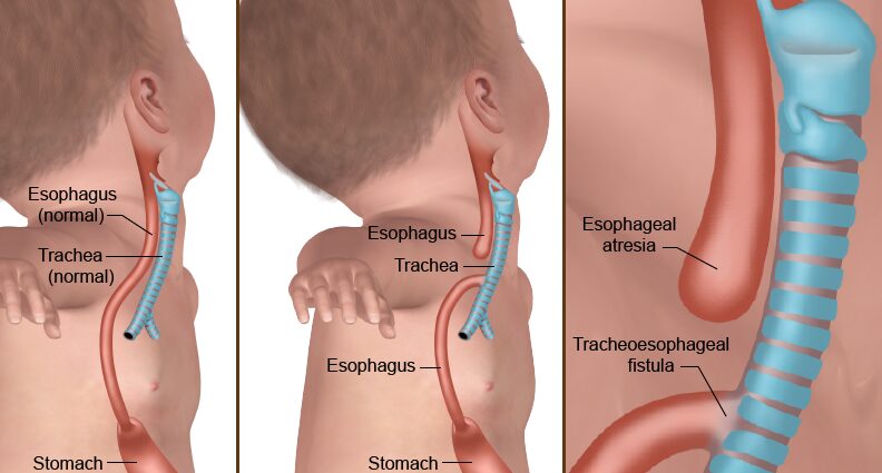 Baby has esophageal atresia