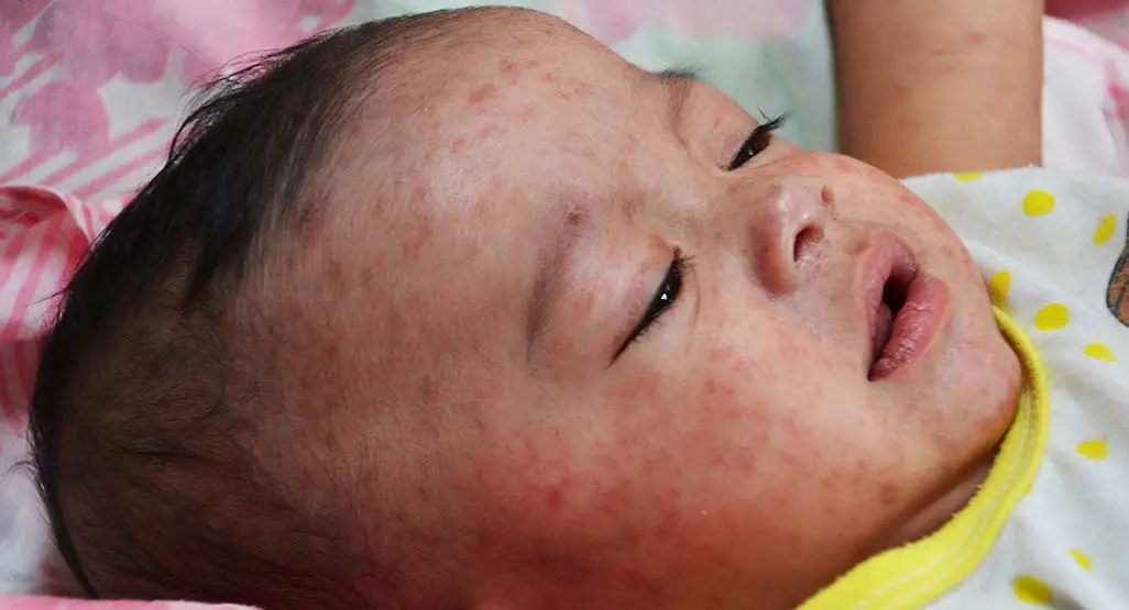 Baby has measles