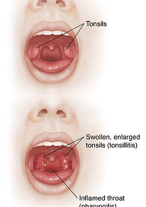 Baby has tonsillitis