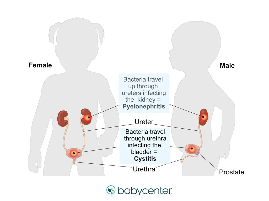 Baby&#8217;s pyelonephritis: everything you need to know